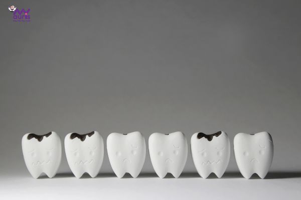  khi nào cần trồng răng implant 