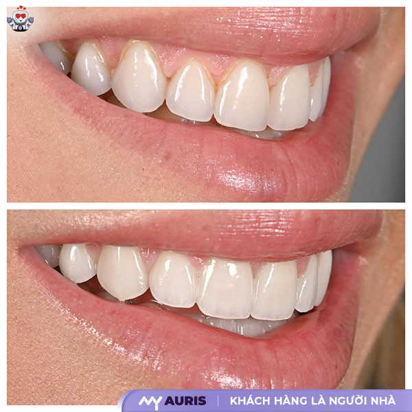khi nào cần bọc răng sứ,có nên bọc răng sứ không,có nên làm răng sứ không