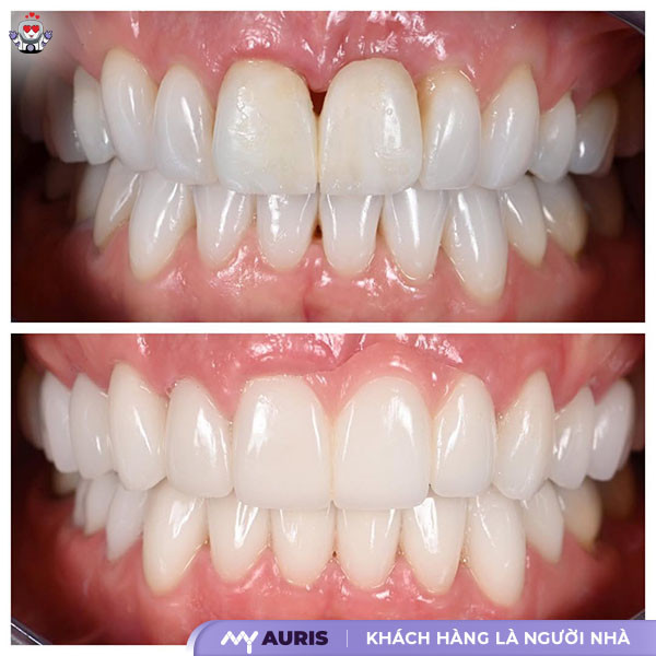 khi nào cần bọc răng sứ,có nên bọc răng sứ không,có nên làm răng sứ không