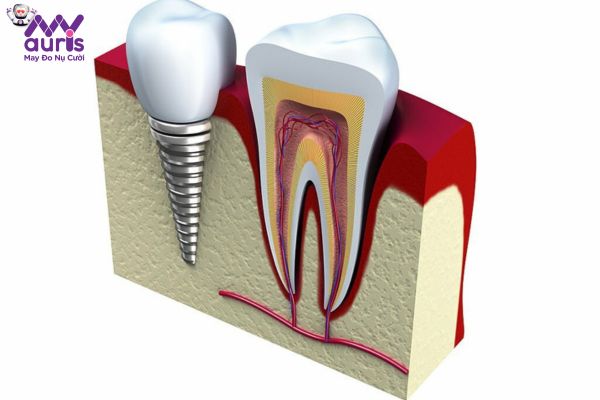 Trường hợp bác sĩ chống chỉ định thực hiện trồng răng Implant