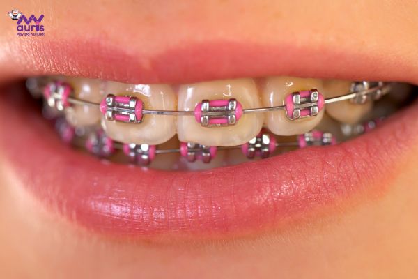 Niềng răng chất lượng - Kinh nghiệm chọn phương pháp chỉnh nha 