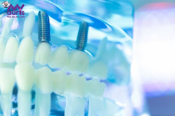 Ưu nhược điểm của phương pháp trồng răng Implant 