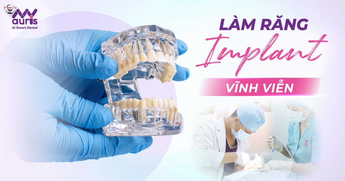 Làm răng Implant vĩnh viễn - 4 yếu tố chính quyết định