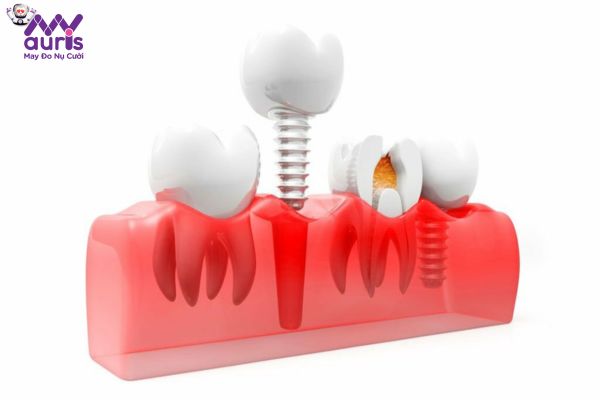 Lợi ích của trồng răng Implant cần biết 