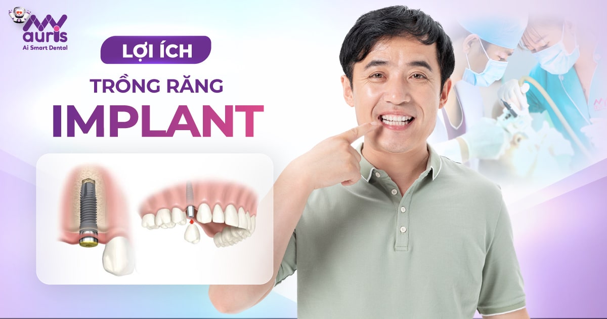 [Chia sẻ] 6 lợi ích của trồng răng Implant cần biết