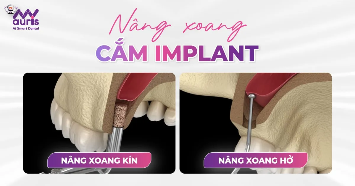 Nâng xoang cắm Implant - 2 kỹ thuật phổ biến điều trị