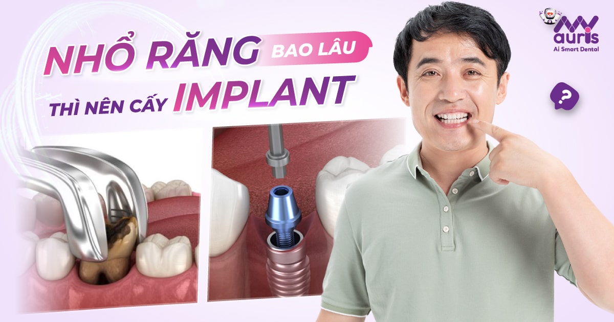 [Giải đáp] Nhổ răng bao lâu thì có thể cấy Implant