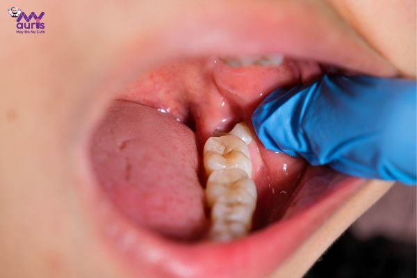 cách giảm đau răng khôn 
