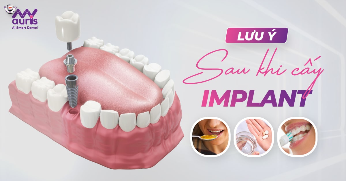 Những lưu ý sau khi cấy Implant (7 điểm cần nhớ)