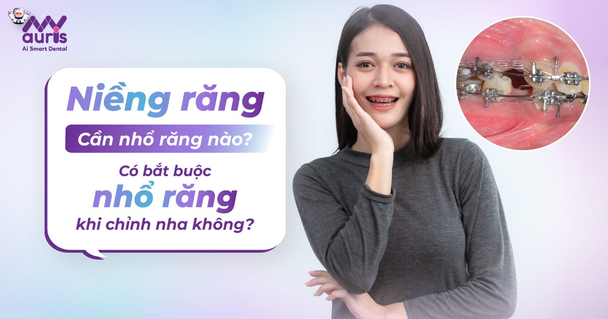 Niềng răng cần nhổ răng nào