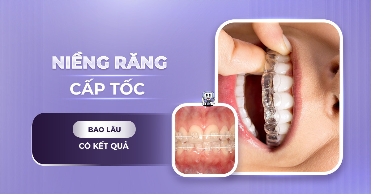 niềng răng cấp tốc