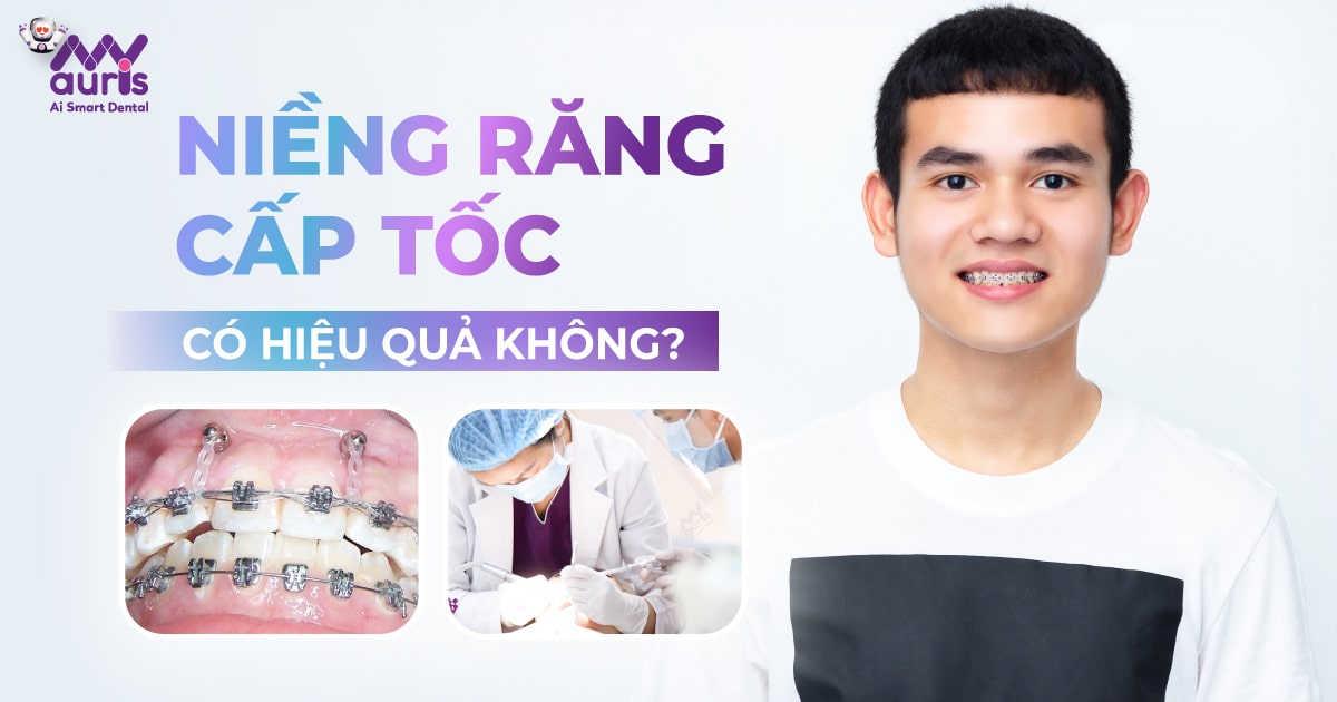 Niềng răng cấp tốc có hiệu quả không?