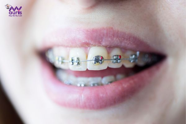 Niềng răng mắc cài kim loại