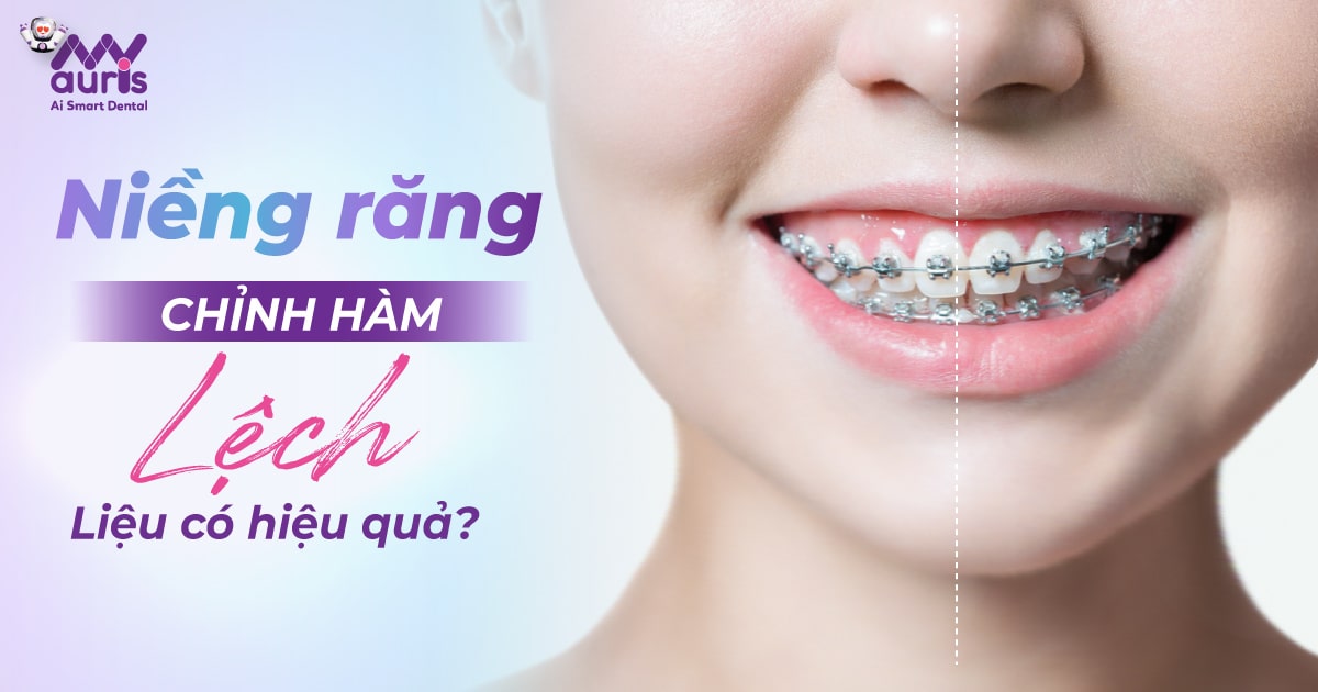 Niềng răng chỉnh hàm lệch