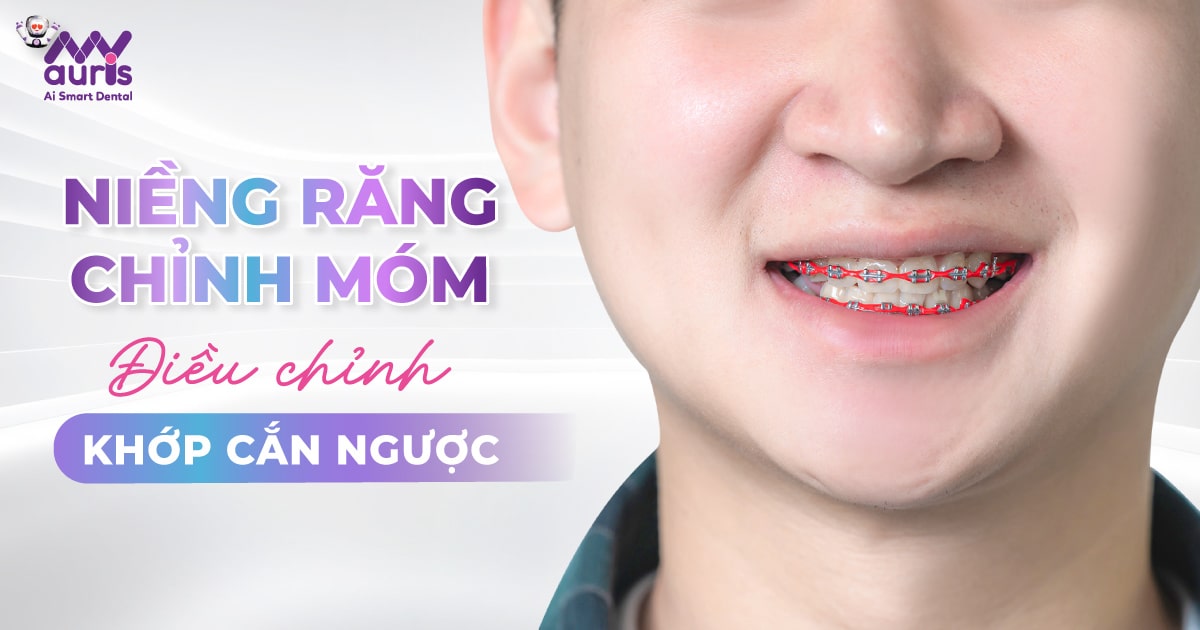 Niềng răng chỉnh móm