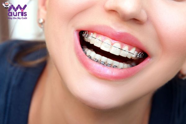 Niềng răng móm có gây đau nhức không?