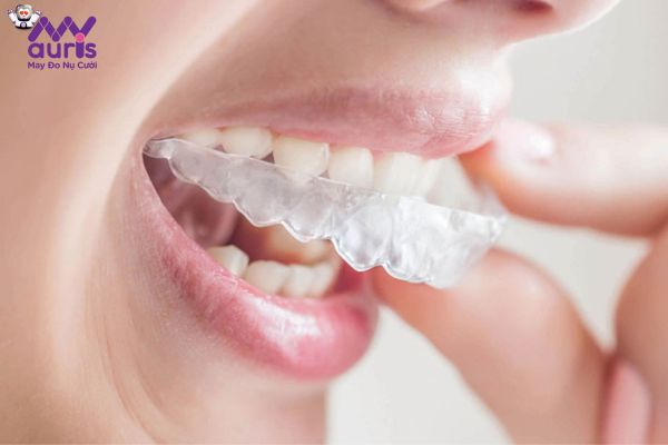 Niềng răng Clear 3D là phương pháp gì?
