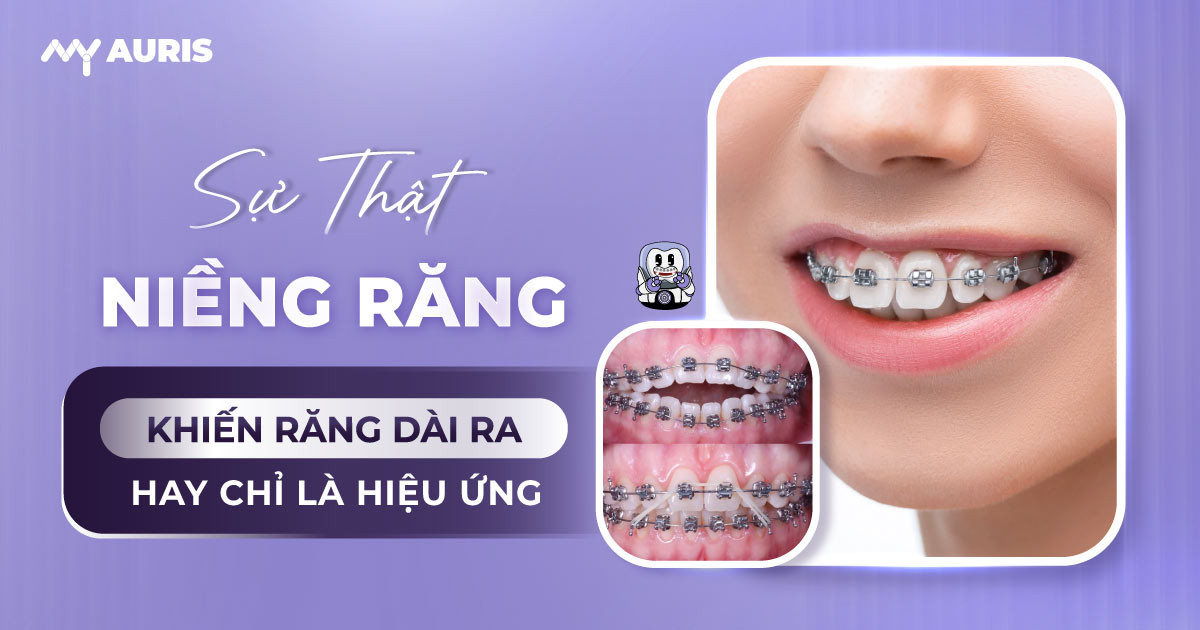 niềng răng có làm răng dài ra không