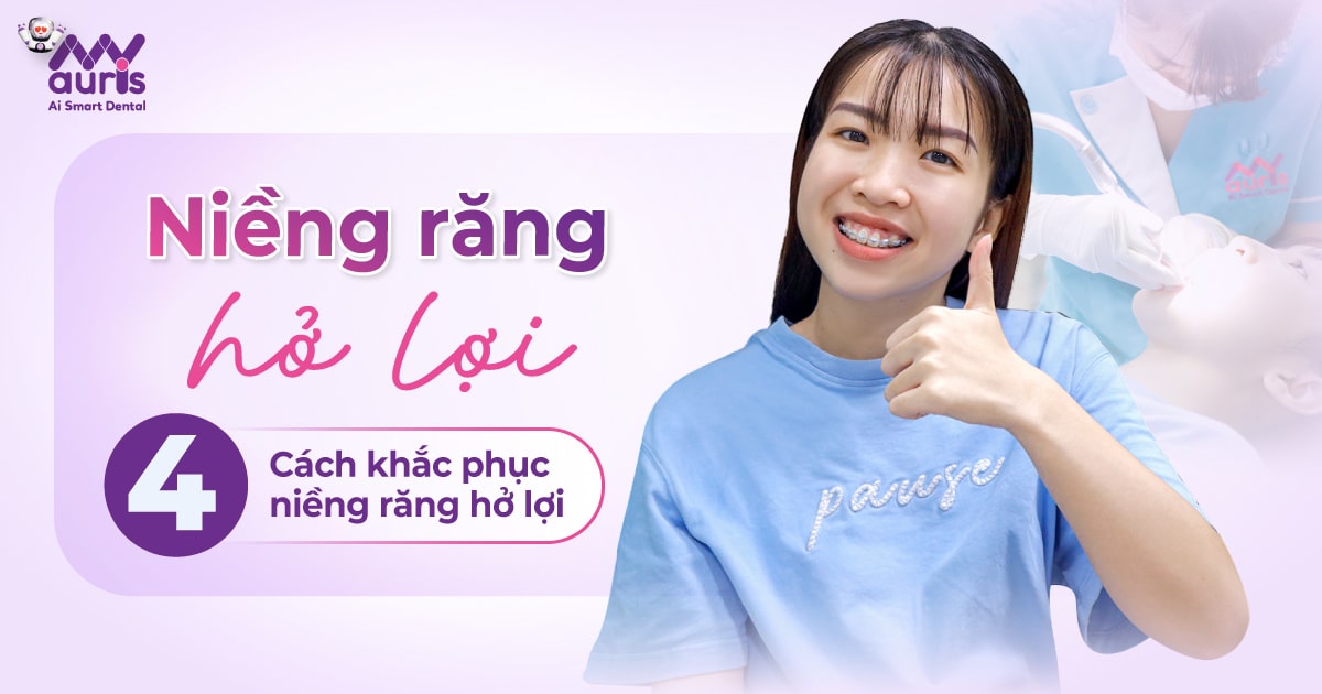 Niềng răng hở lợi