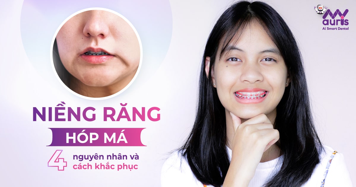 Niềng răng hóp má