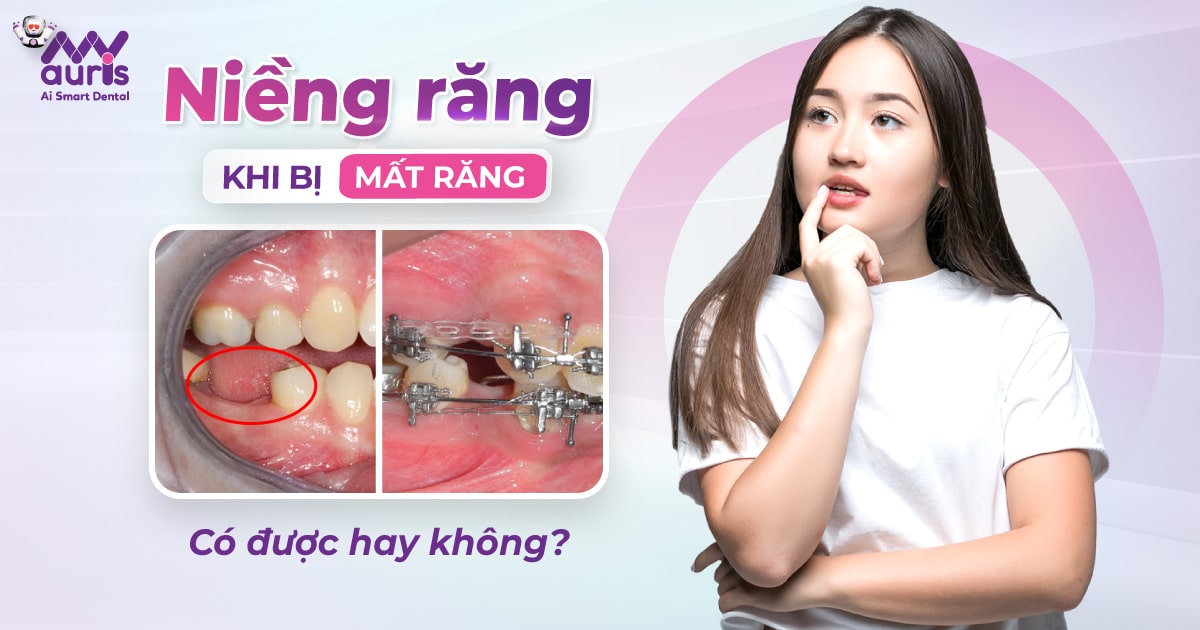 Niềng răng khi bị mất răng có được hay không?