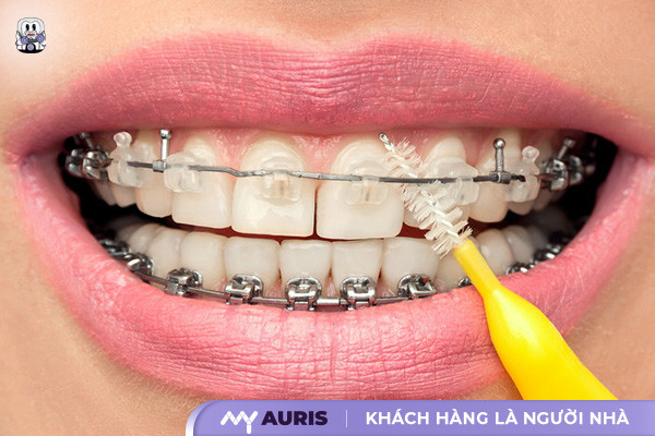 niềng răng cần kiêng gì,niềng răng có kiêng gì không