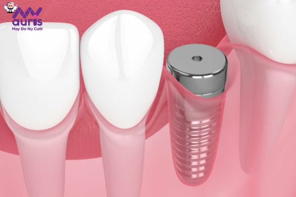 Giải đáp quy trình trồng răng Implant mất thời gian bao lâu?