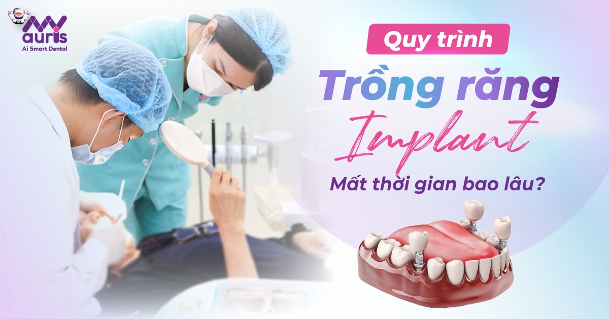 Quy trình trồng răng implant mất thời gian bao lâu?