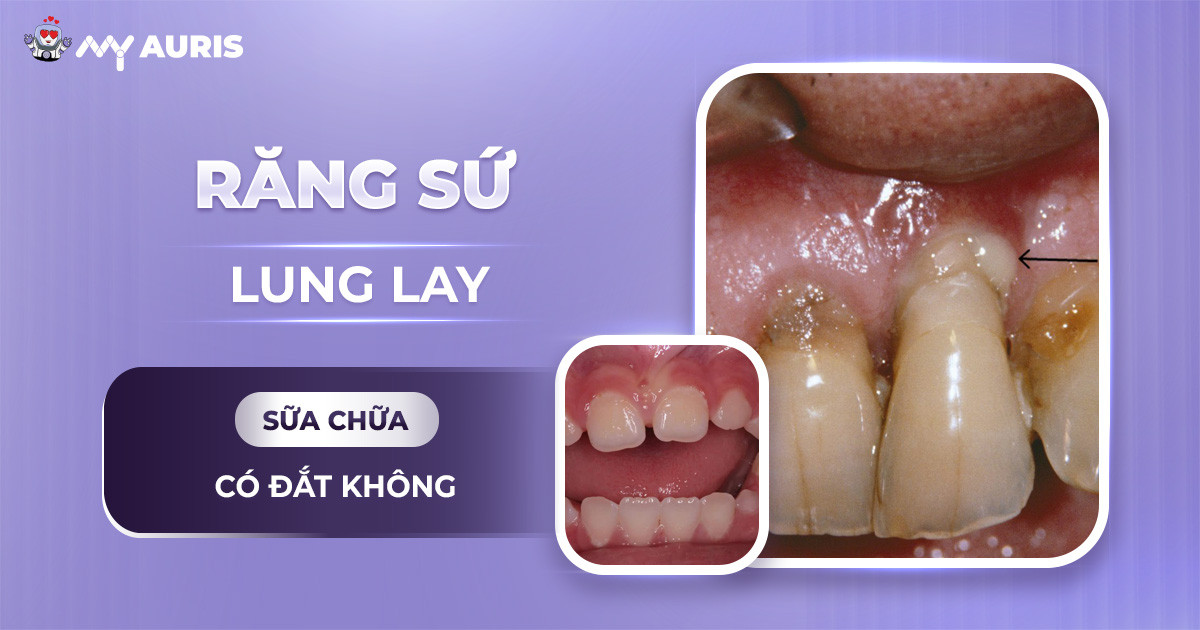 răng sứ bị lung lay, răng sứ lung lay, răng bọc sứ bị lung lay