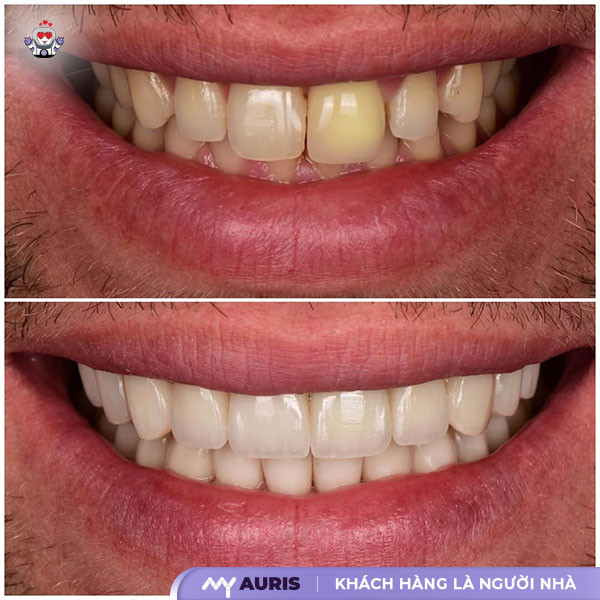 răng sứ khi về già,làm răng sứ về già có sao không,răng sứ kim loại