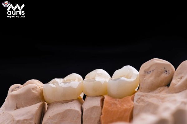 Quy trình làm răng sứ toàn sứ Sagemax diễn ra trong bao lâu?