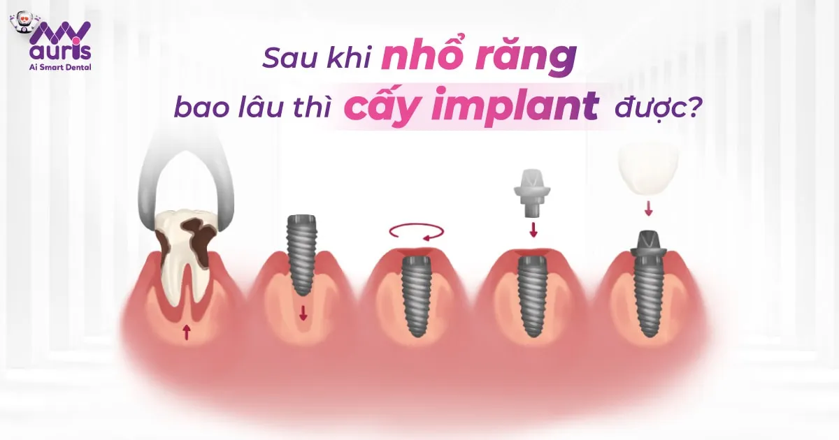 Tư vấn sau khi nhổ răng bao lâu thì cấy Implant được?