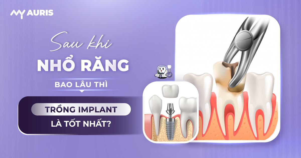 Sau khi nhổ răng bao lâu thì trồng implant,mới nhổ răng có trồng implant được không,nhổ răng bao lâu thì cắm implant,sau khi nhổ răng bao lâu thì cấy implant được,cấy ghép implant sau khi nhổ răng