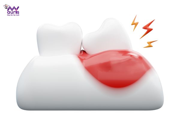 cách giảm đau khi mọc răng khôn 