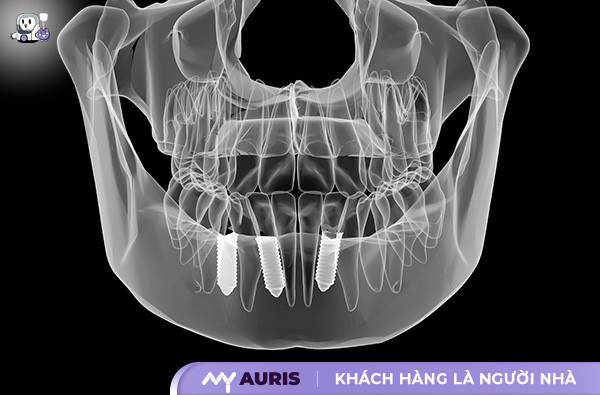 implant dưới màng xương