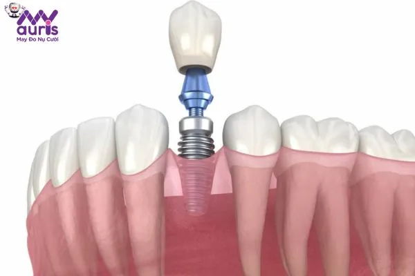 Thực hiện trồng răng sứ Implant là phương pháp được hiểu như thế nào?