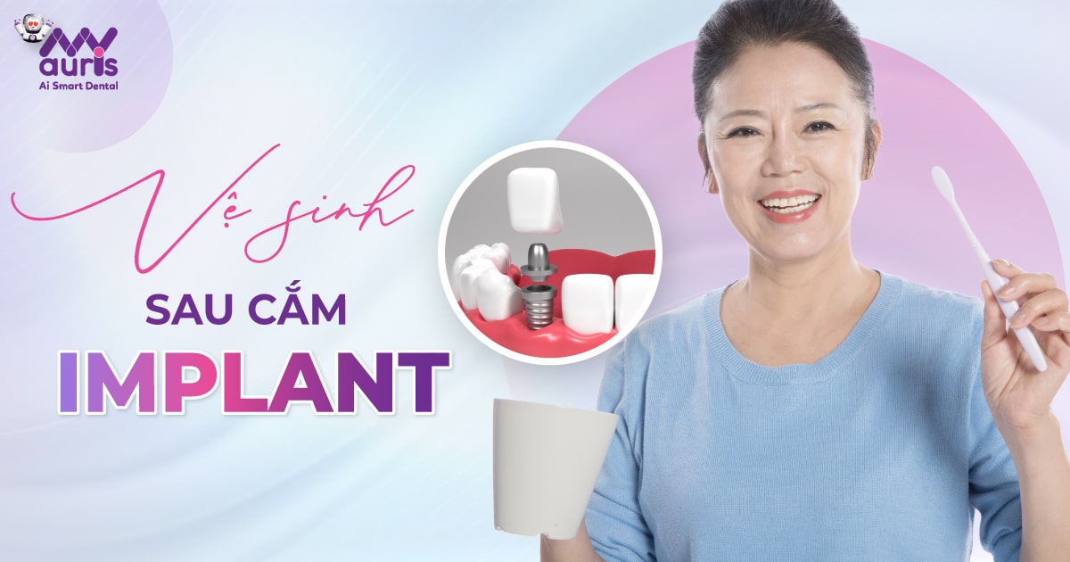 Vệ sinh sau cắm Implant (Hướng dẫn chải răng an toàn)