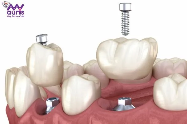 Bé 16 tuổi trồng răng Implant được không?