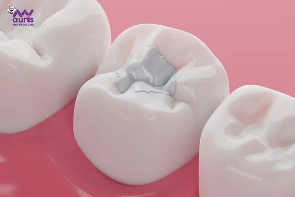  cách phục hồi răng bị mẻ tại nhà 