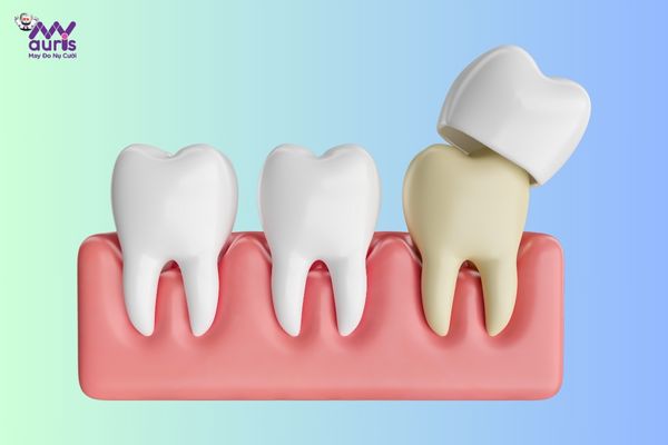  cách phục hồi răng bị mẻ tại nhà 