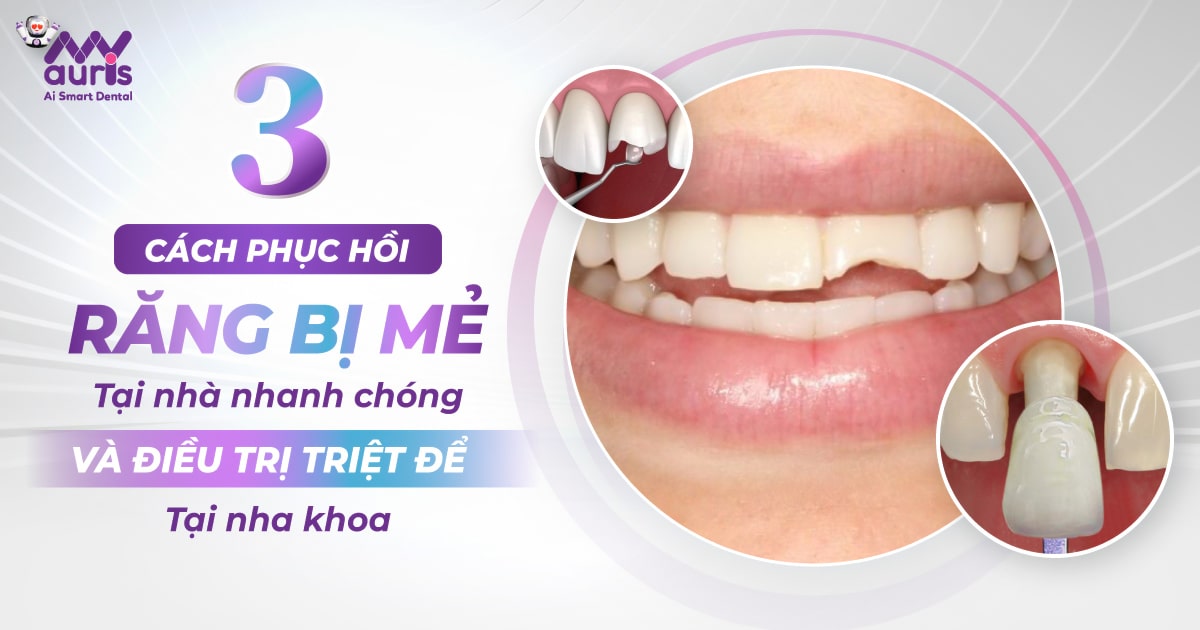 3 cách phục hồi răng bị mẻ tại nhà nhanh chóng