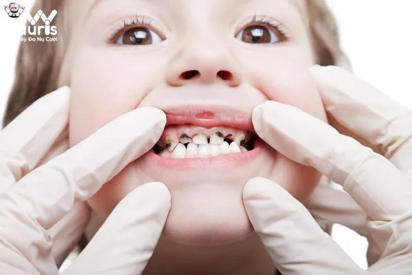 Ảnh hưởng của sâu răng đối với sức khỏe của trẻ