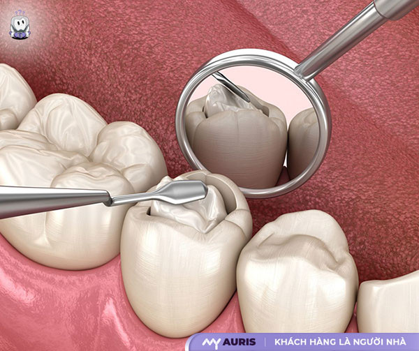 bị mẻ răng cửa,bị mẻ răng cửa là điềm gì,bị mẻ răng cửa phải làm sao