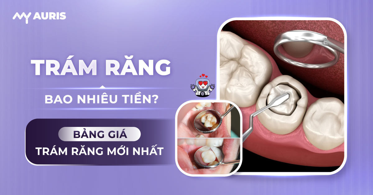 bảng giá trám răng