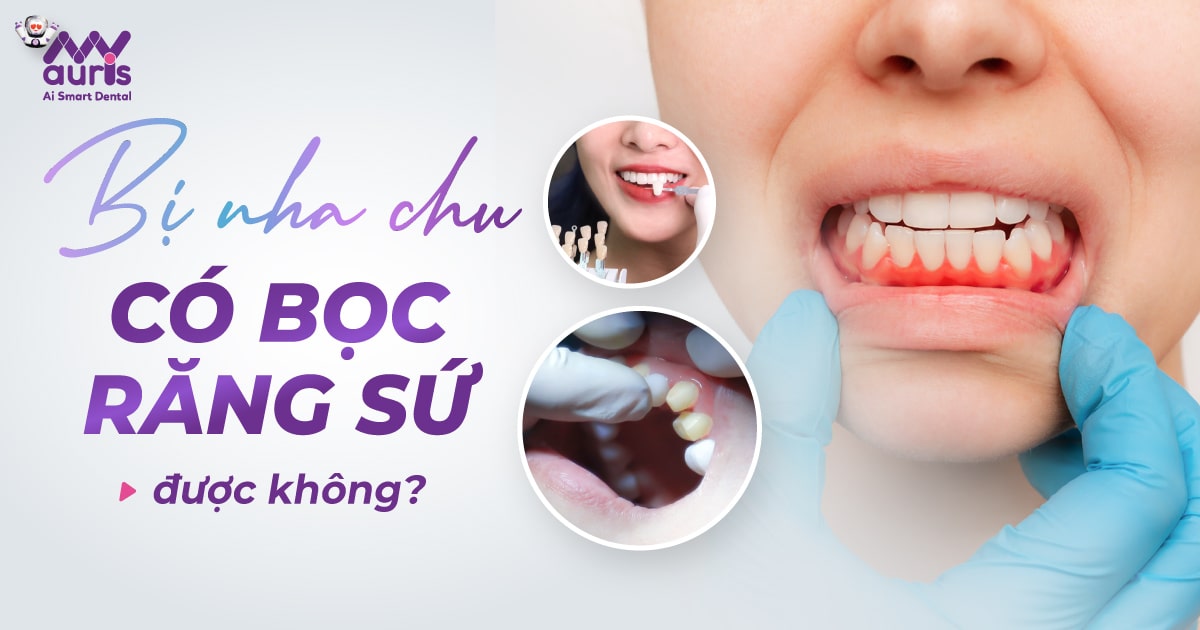 [Tư vấn] Bị nha chu có bọc răng sứ được không?