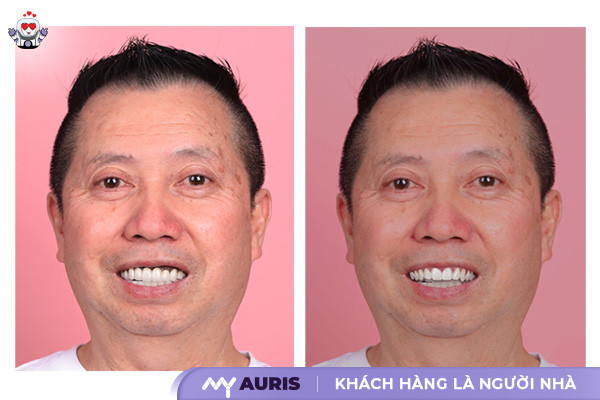 bọc răng sứ sinh trắc học,bọc răng sứ sinh học,BioMetric Smile ,nha khoa cao cấp ,bọc sứ VIP ,Phủ sứ VIP ,Thiết kế nụ cười sinh trắc học,lợi ích thẩm mỹ răng sứ