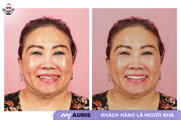 bọc răng sứ sinh trắc học,bọc răng sứ sinh học,BioMetric Smile ,nha khoa cao cấp ,bọc sứ VIP ,Phủ sứ VIP ,Thiết kế nụ cười sinh trắc học,lợi ích thẩm mỹ răng sứ