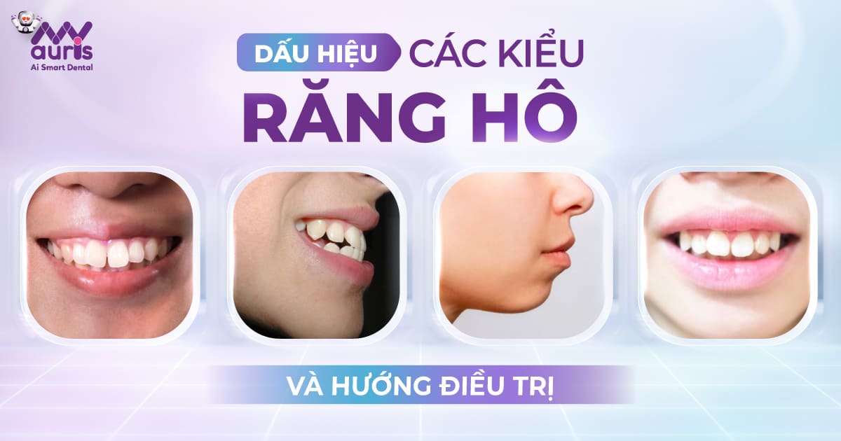 các kiểu răng hô