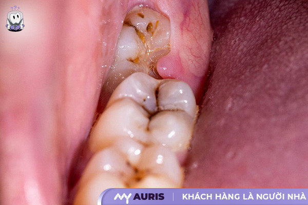 Cách giảm đau răng khôn bị sâu