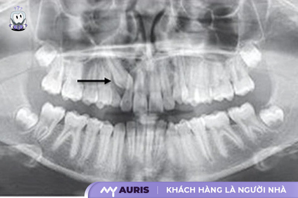 cách giảm đau răng nhanh nhất